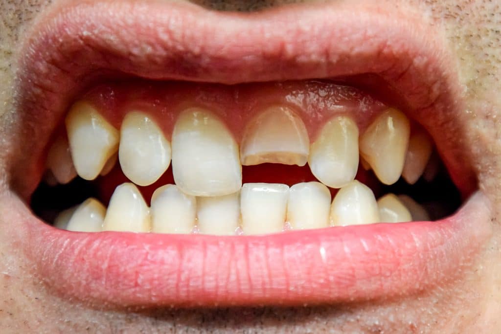 Can A Cracked Tooth Heal On Its Own?