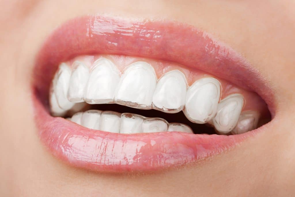 How Long Do You Have To Wear Invisalign?